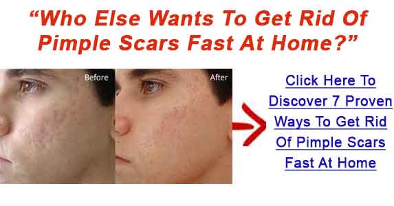 Get-Rid-Of-Pimple-Scars-Bnr1