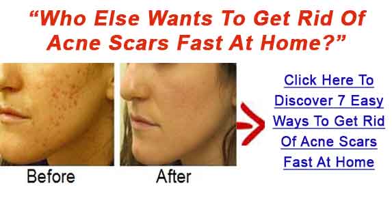 Get-Rid-Of-Pimple-Scars-Bnr2