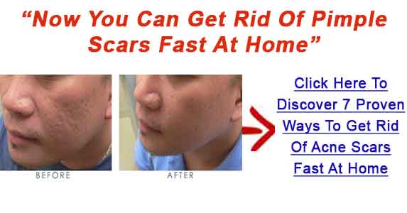 copy96_Get-Rid-Of-Pimple-Scars-Bnr3