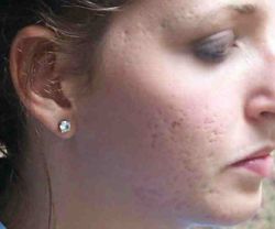 get-rid-of-acne-scars-06