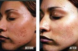 get-rid-of-acne-scars-09